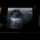 Warthin tumor, parotid gland: US - Ultrasound